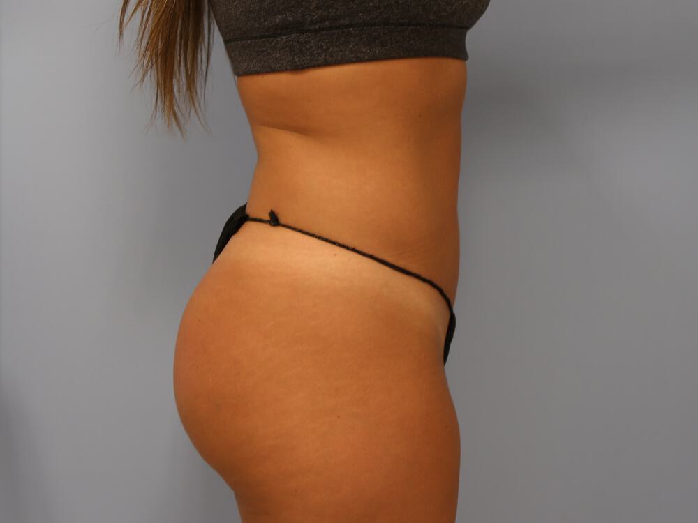 Buttocks Reshaping Before & After Image