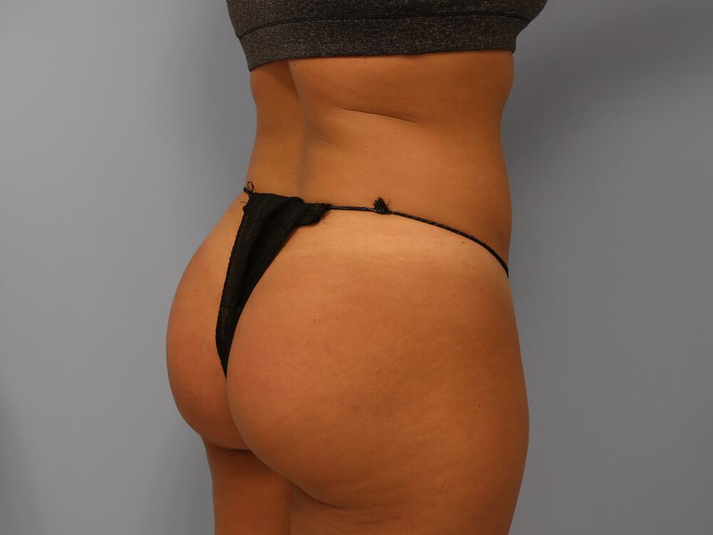 Buttocks Reshaping Before & After Image