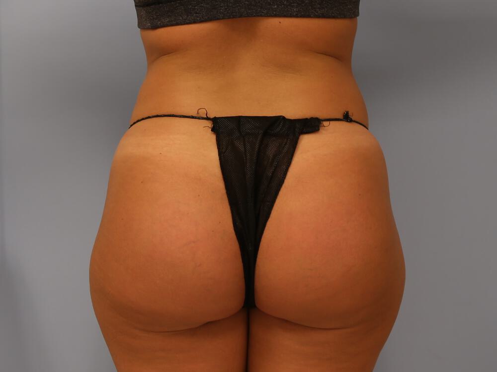 Buttocks Reshaping Before & After Image