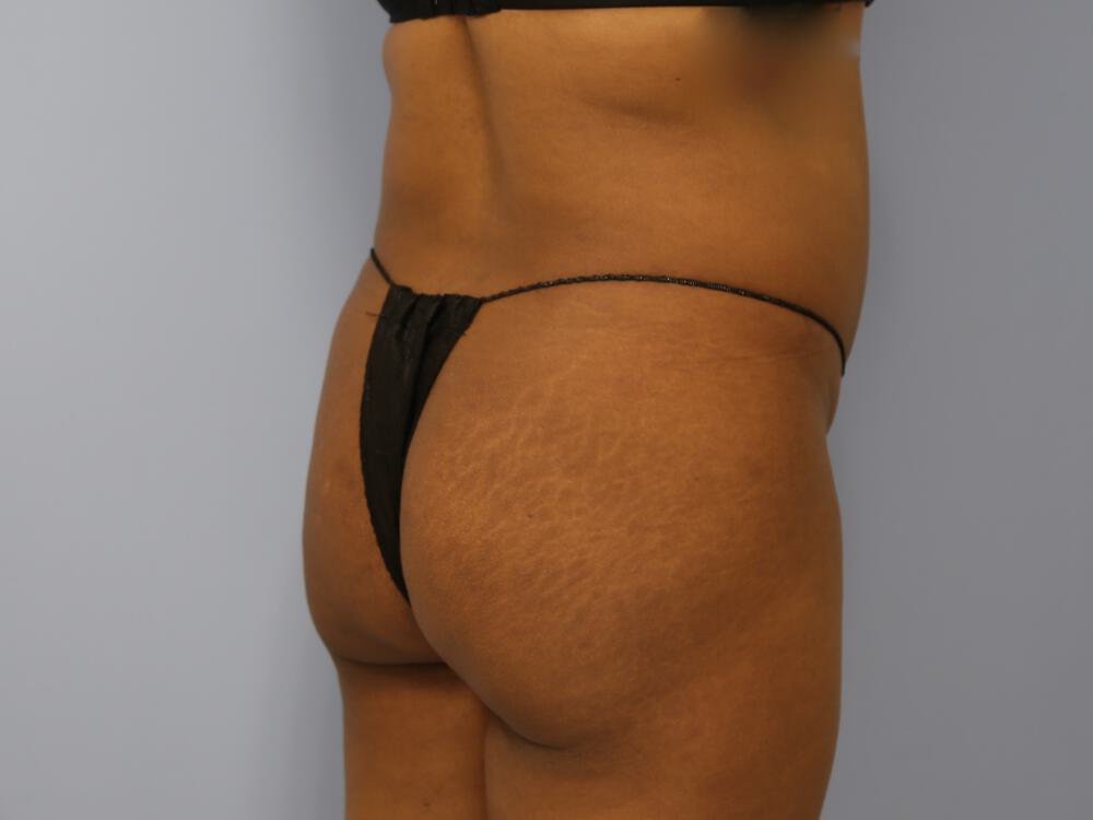 Buttocks Reshaping Before & After Image
