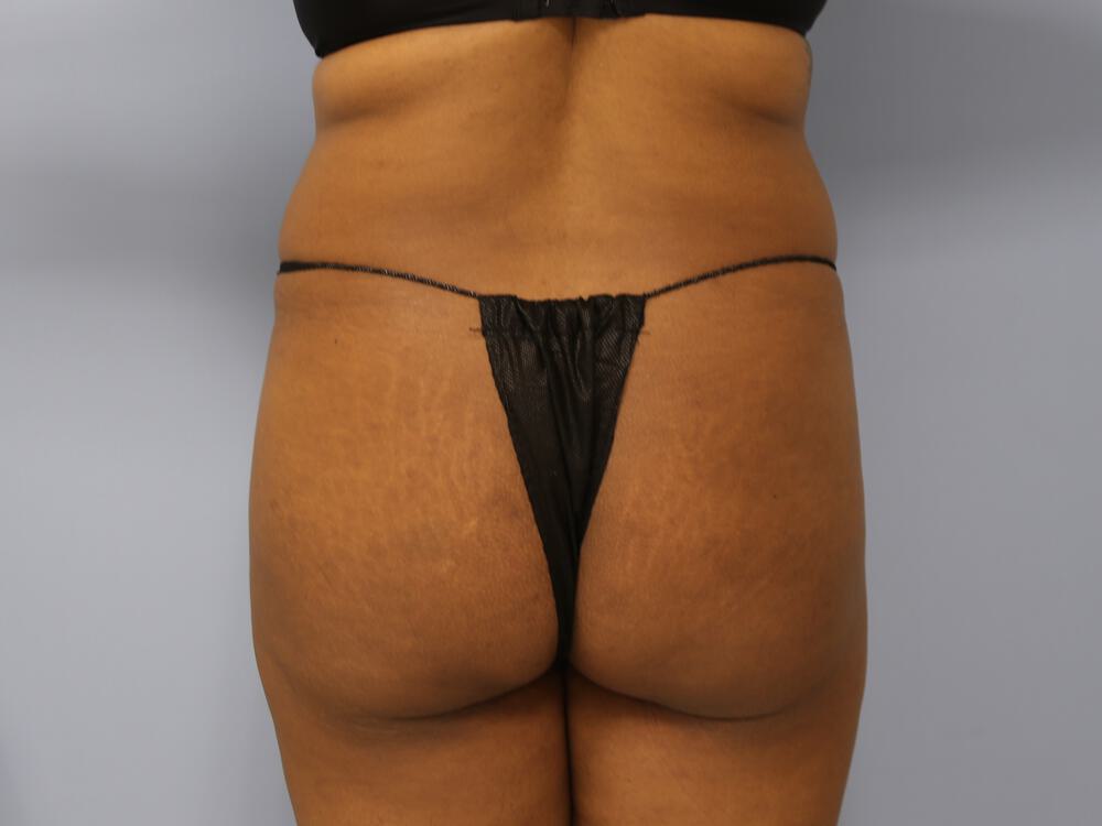 Buttocks Reshaping Before & After Image