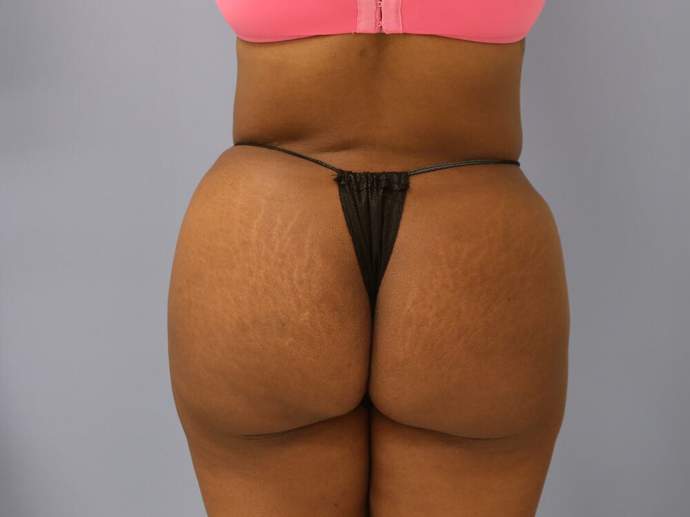 Buttocks Reshaping Before & After Image