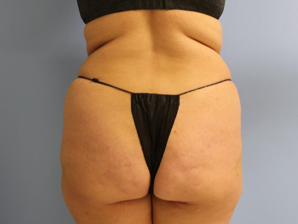 Buttocks Reshaping Before & After Image