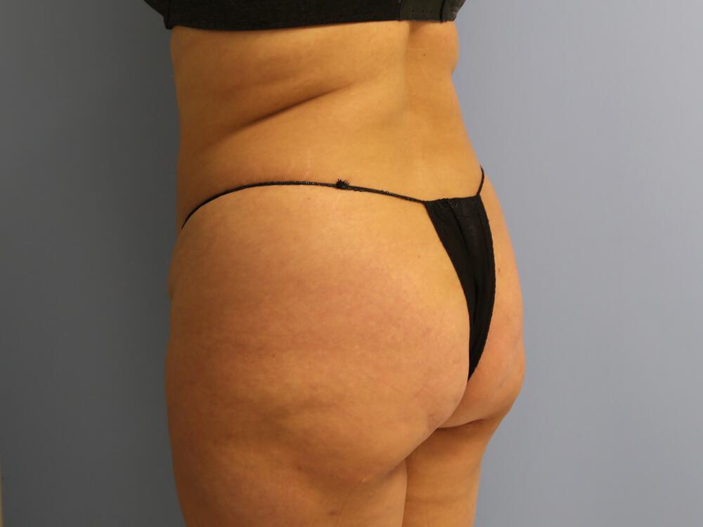 Buttocks Reshaping Before & After Image