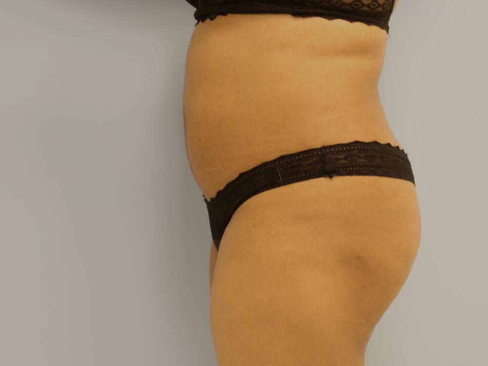 Buttocks Reshaping Before & After Image