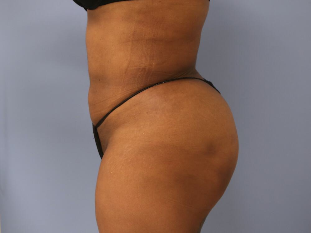Buttocks Reshaping Before & After Image