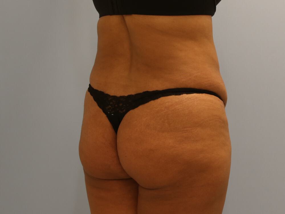 Buttocks Reshaping Before & After Image