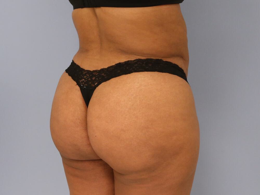 Buttocks Reshaping Before & After Image