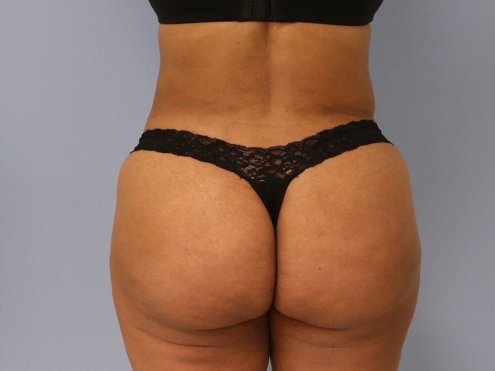 Buttocks Reshaping Before & After Image