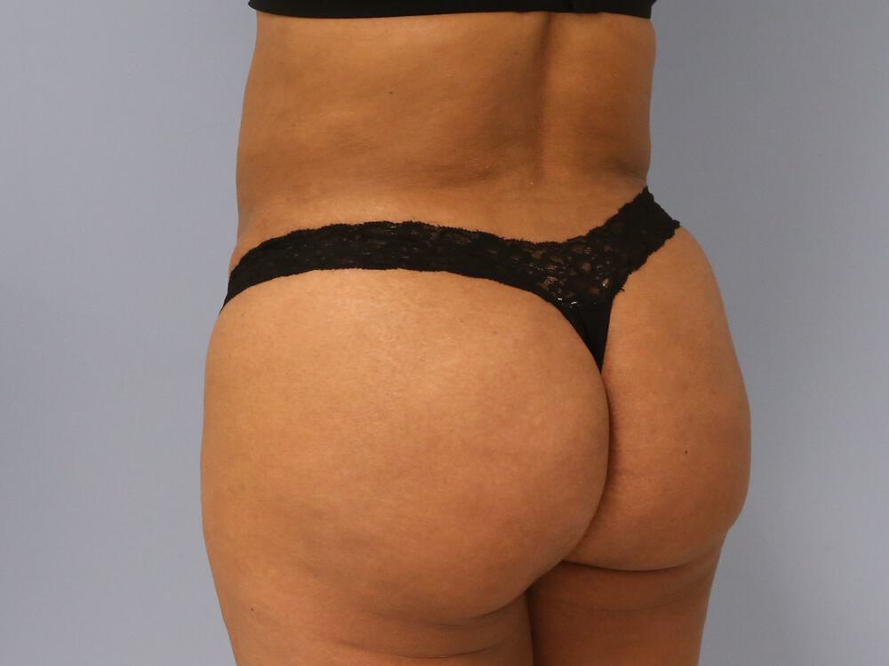 Buttocks Reshaping Before & After Image