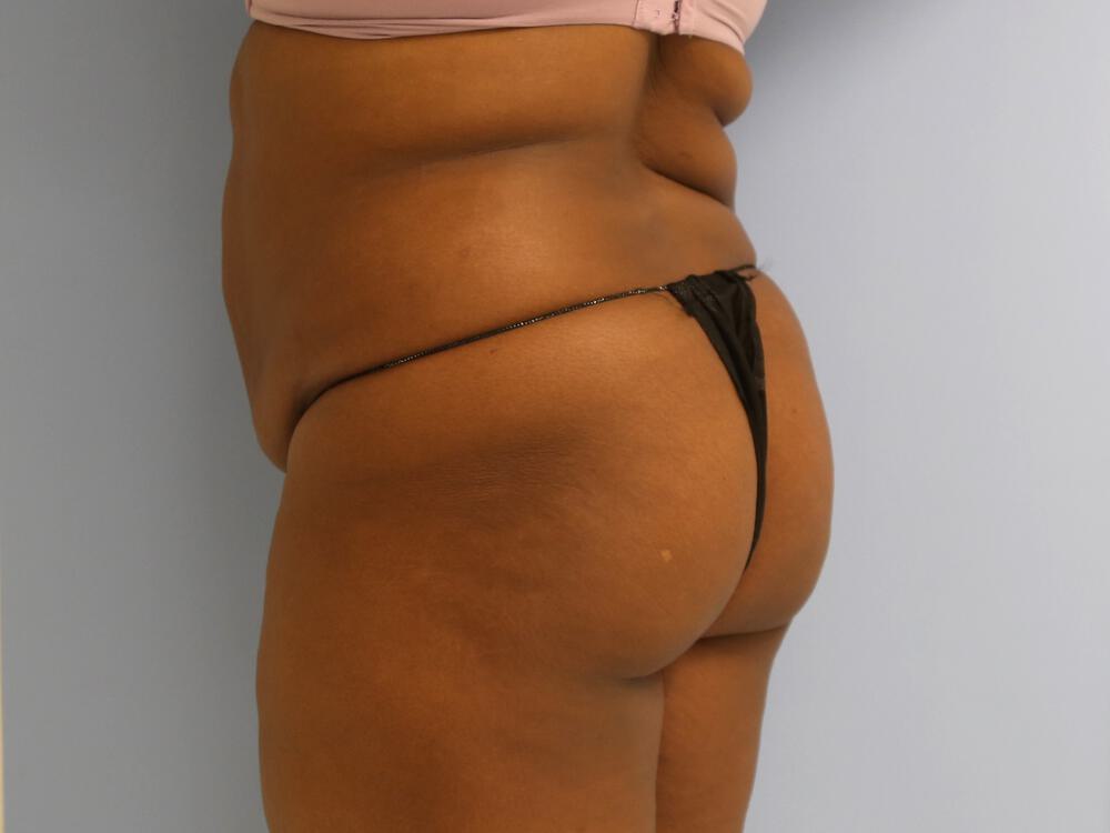 Buttocks Reshaping Before & After Image