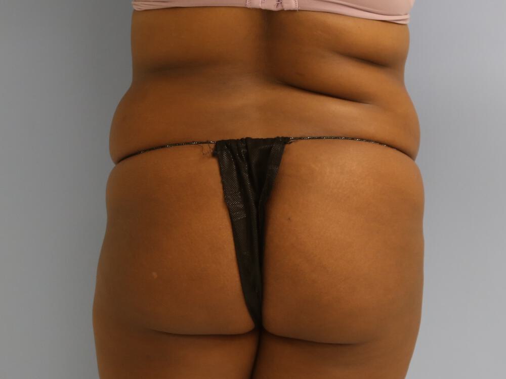 Buttocks Reshaping Before & After Image