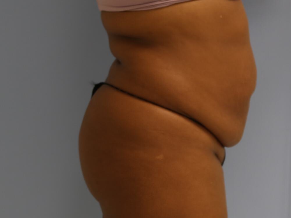 Buttocks Reshaping Before & After Image