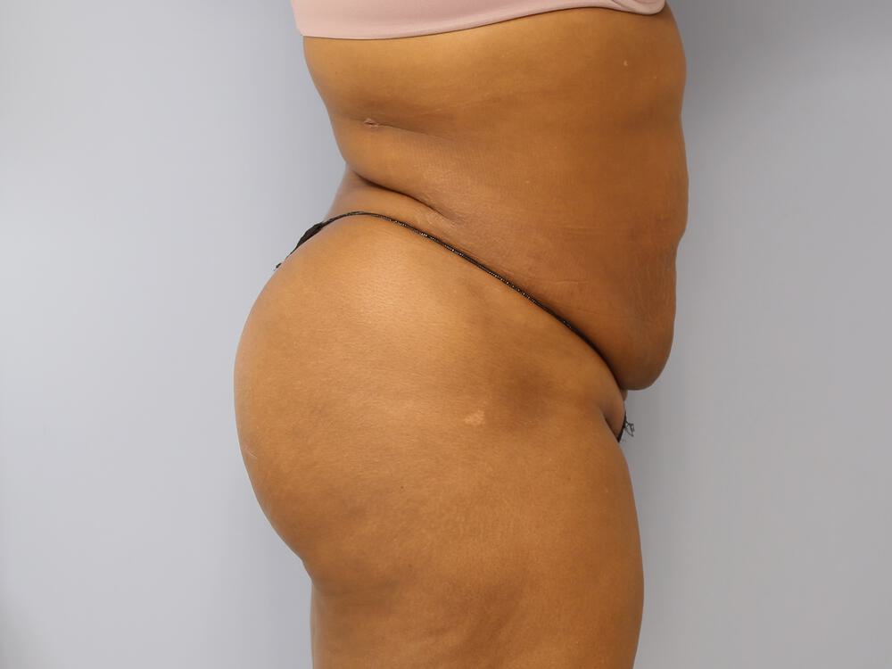 Buttocks Reshaping Before & After Image