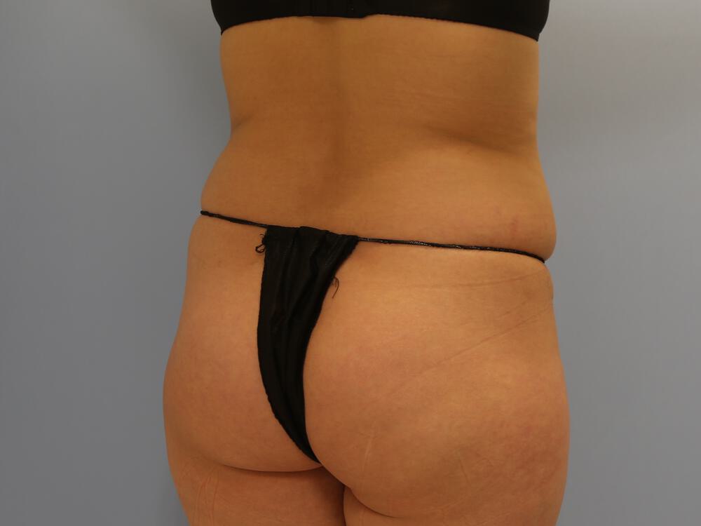 Buttocks Reshaping Before & After Image