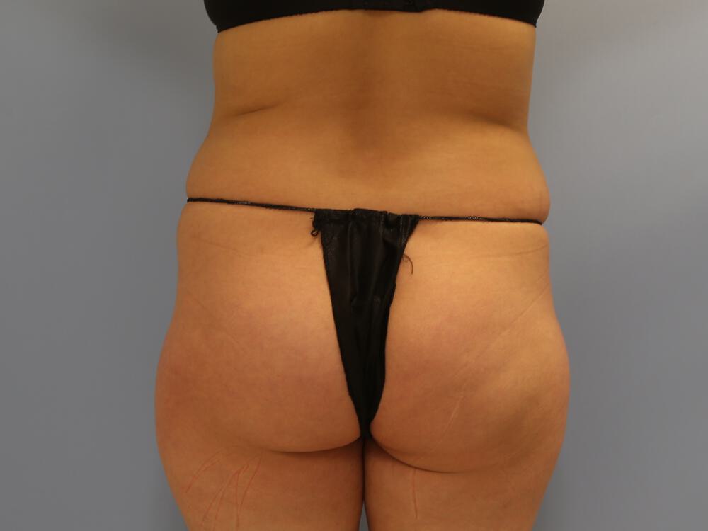 Buttocks Reshaping Before & After Image