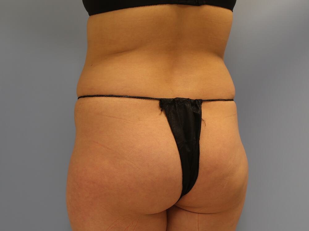 Buttocks Reshaping Before & After Image