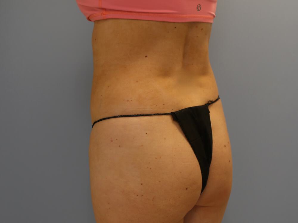 Buttocks Reshaping Before & After Image