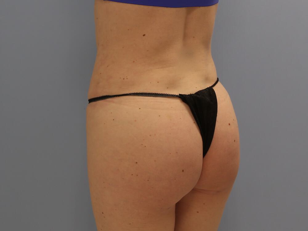 Buttocks Reshaping Before & After Image