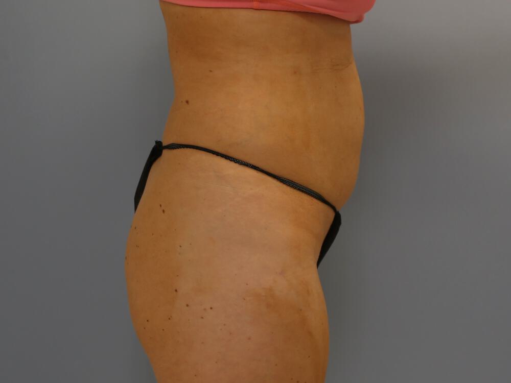 Buttocks Reshaping Before & After Image