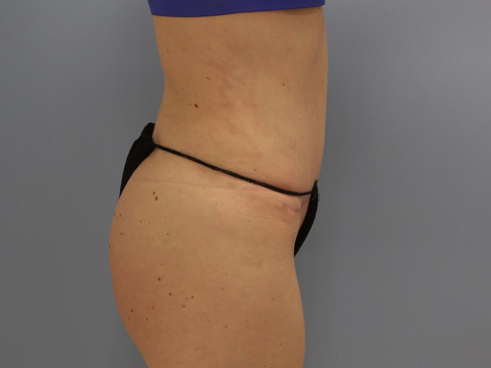 Buttocks Reshaping Before & After Image
