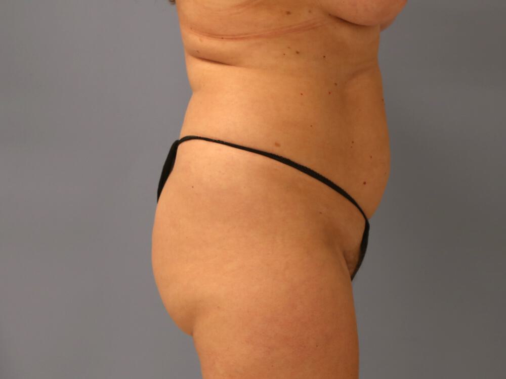 Buttocks Reshaping Before & After Image