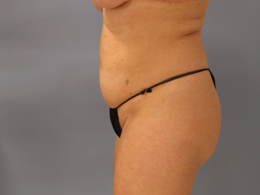 Buttocks Reshaping Before & After Image