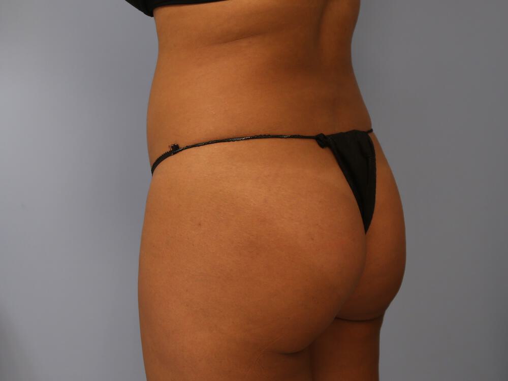 Buttocks Reshaping Before & After Image