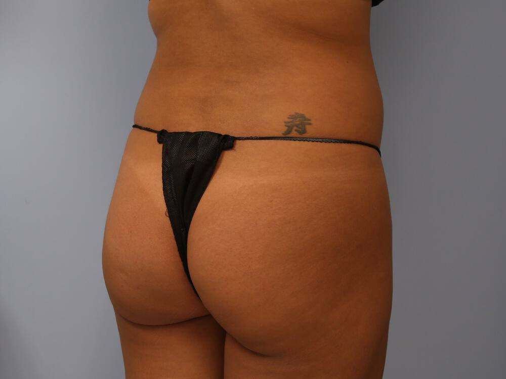 Buttocks Reshaping Before & After Image