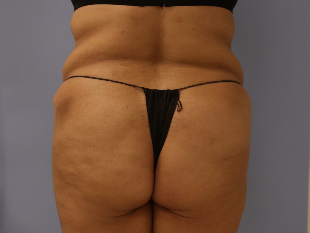 Buttocks Reshaping Before & After Image