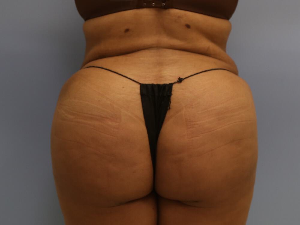 Buttocks Reshaping Before & After Image