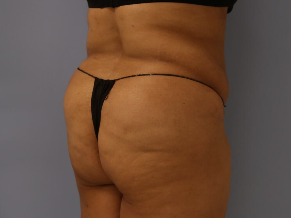 Buttocks Reshaping Before & After Image