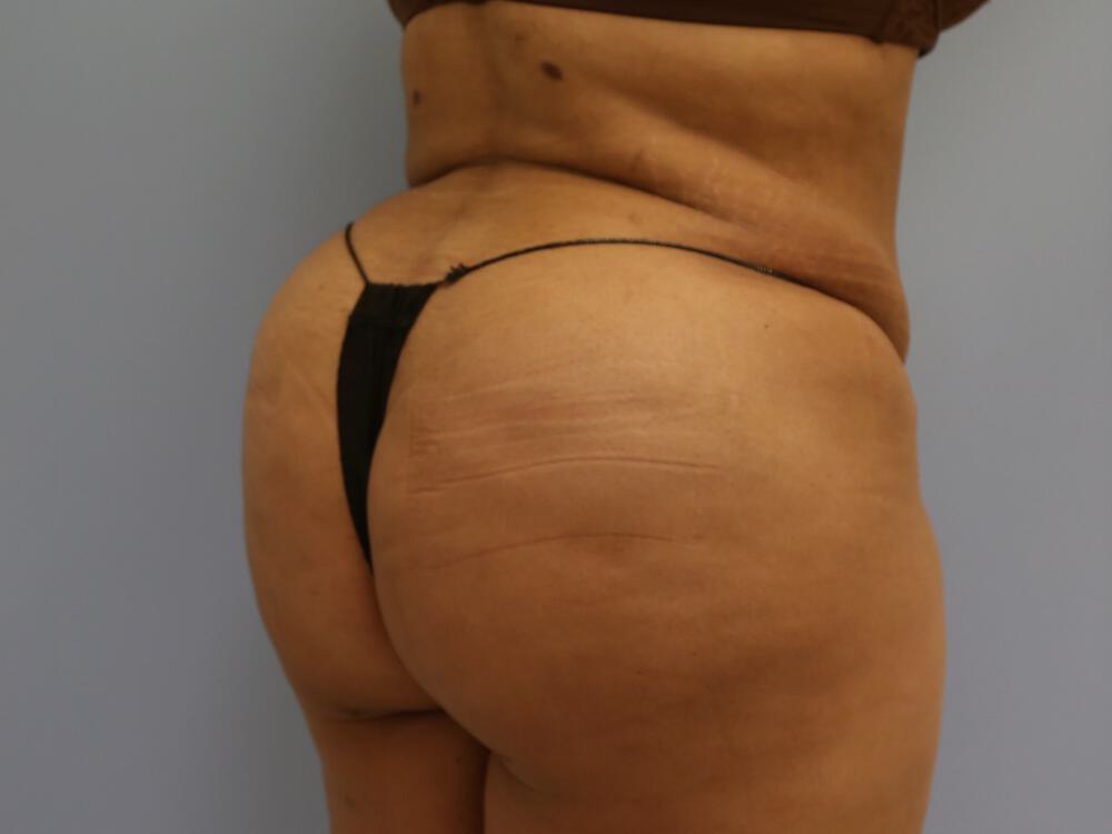 Buttocks Reshaping Before & After Image