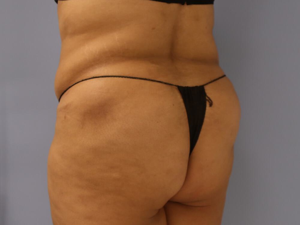 Buttocks Reshaping Before & After Image