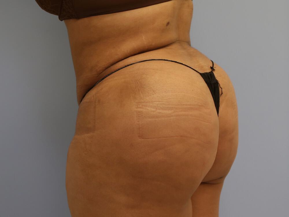 Buttocks Reshaping Before & After Image