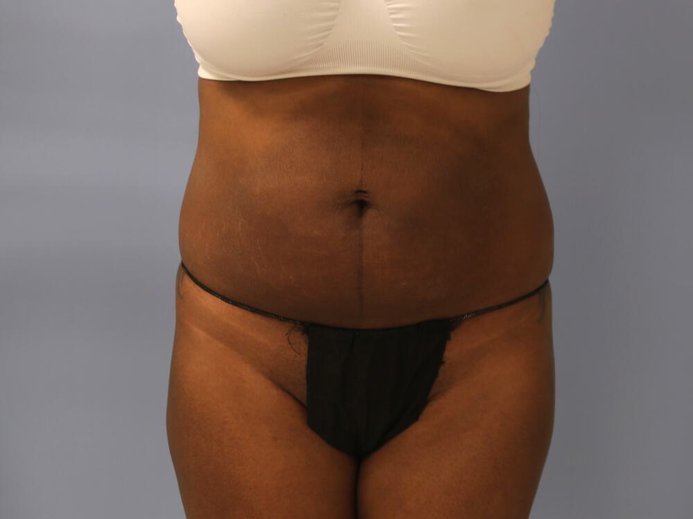 Buttocks Reshaping Before & After Image