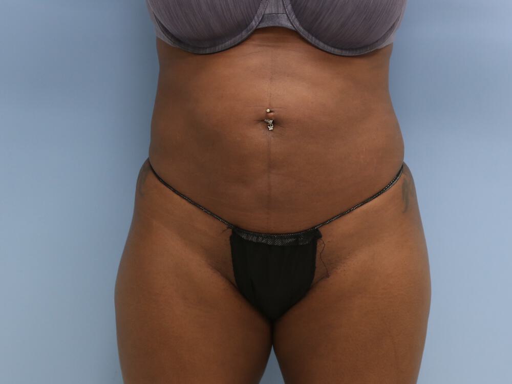 Buttocks Reshaping Before & After Image