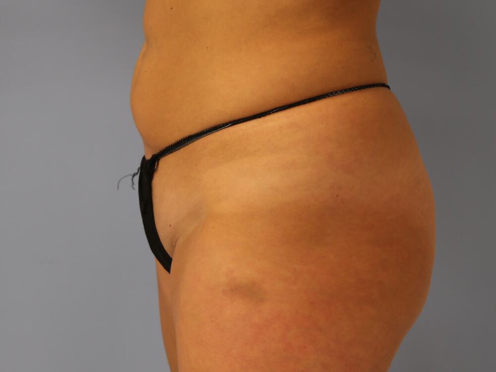 Buttocks Reshaping Before & After Image