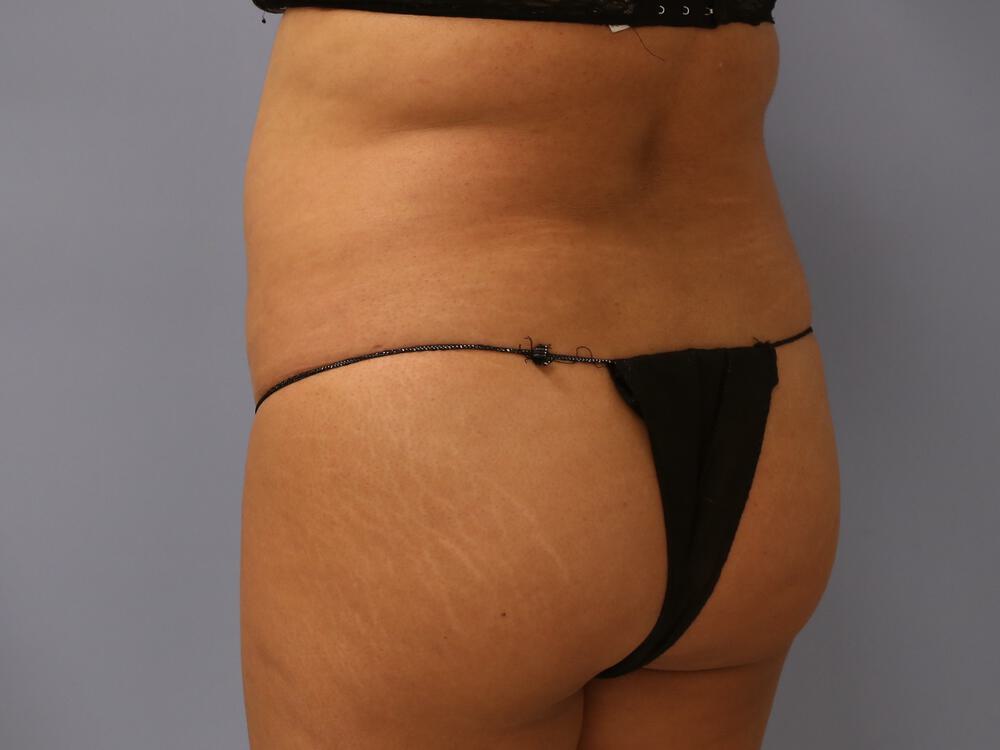 Buttocks Reshaping Before & After Image