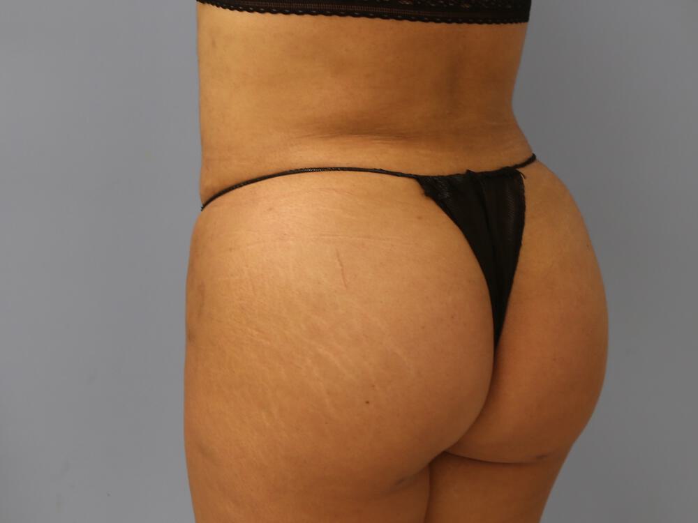 Buttocks Reshaping Before & After Image