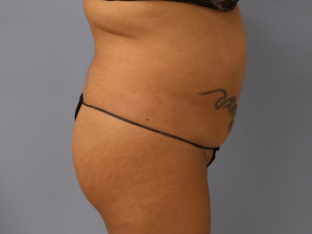 Buttocks Reshaping Before & After Image