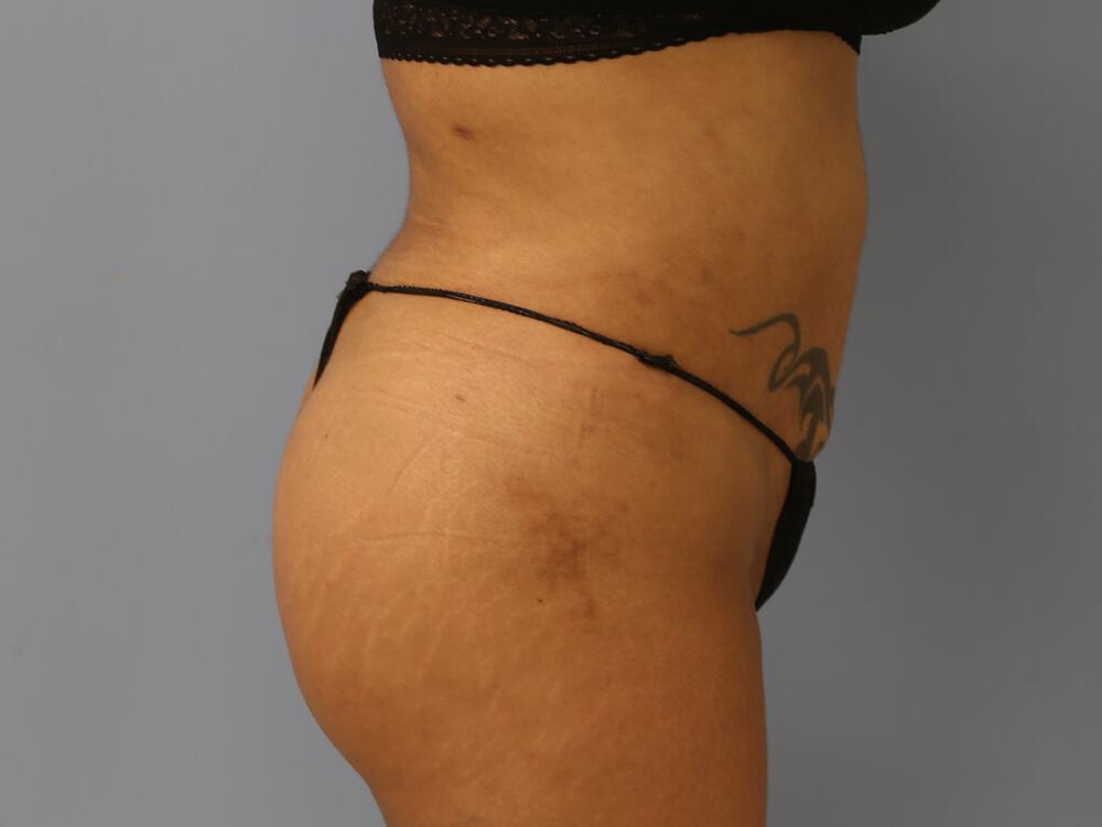Buttocks Reshaping Before & After Image