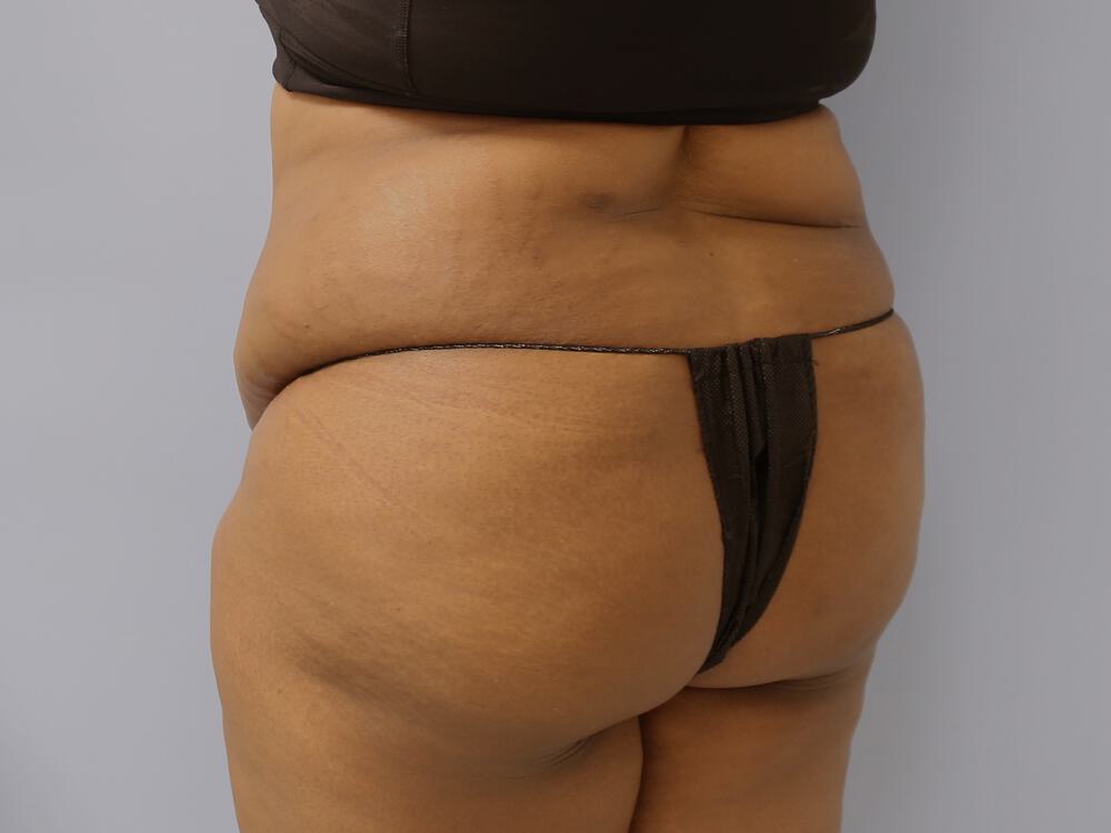 Buttocks Reshaping Before & After Image