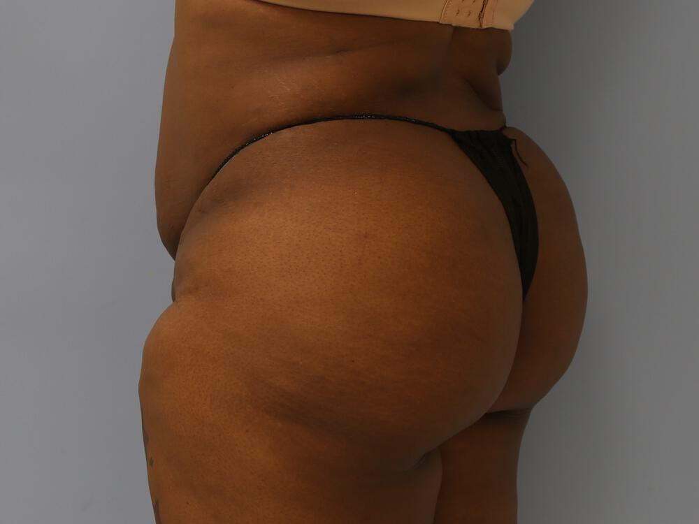 Buttocks Reshaping Before & After Image
