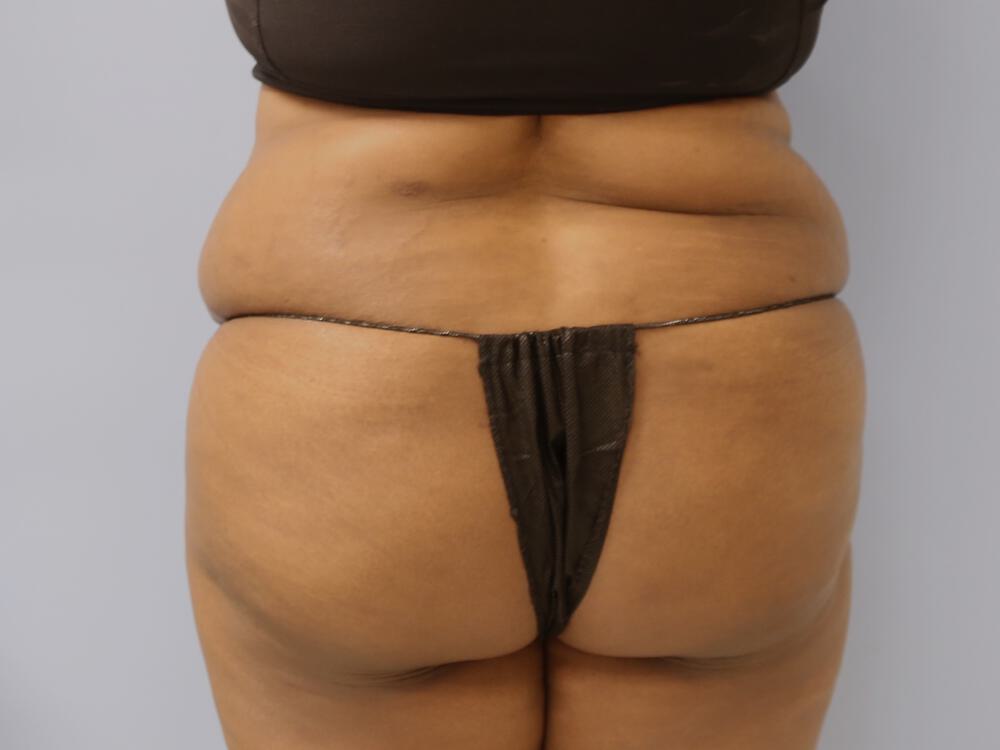 Buttocks Reshaping Before & After Image
