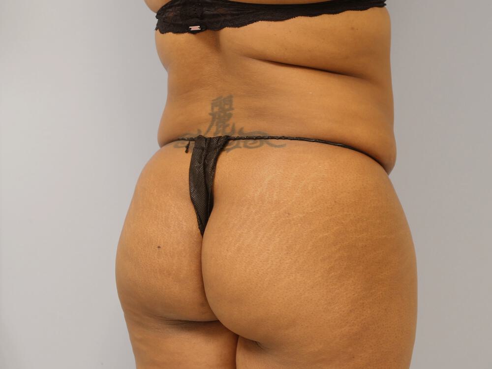 Buttocks Reshaping Before & After Image