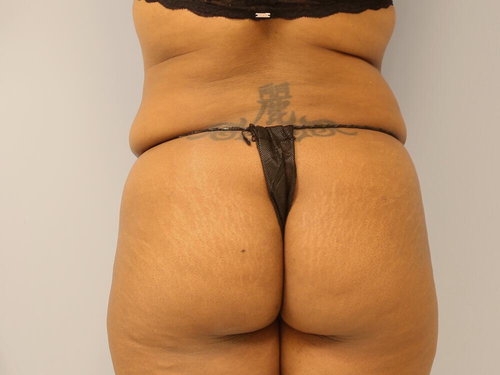 Buttocks Reshaping Before & After Image