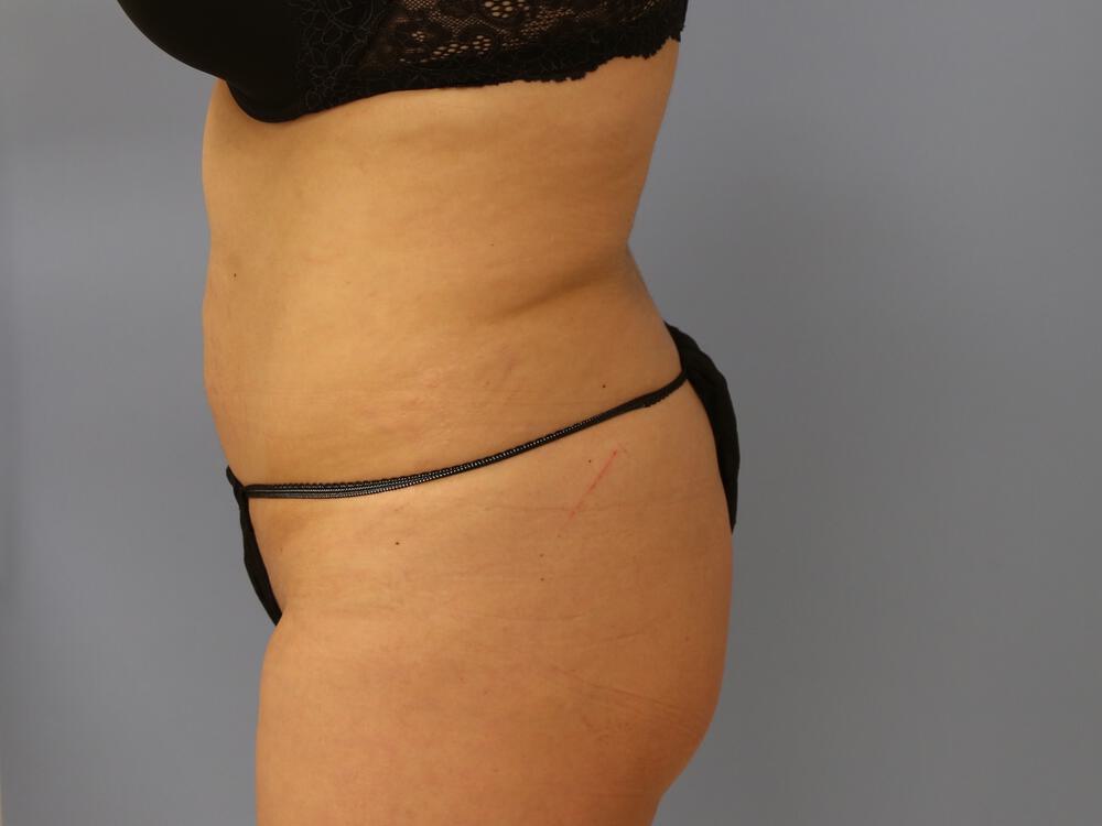 Buttocks Reshaping Before & After Image