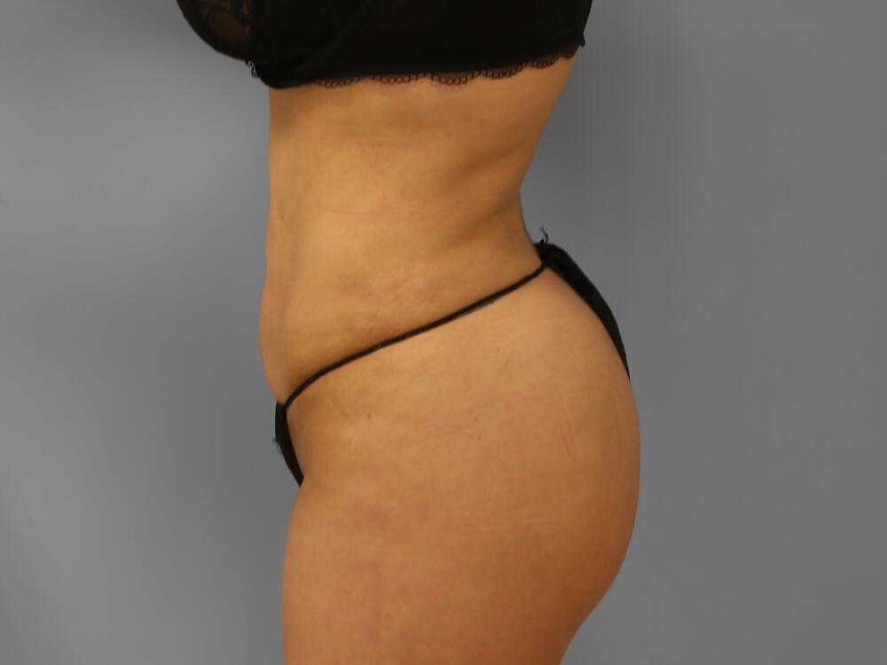 Buttocks Reshaping Before & After Image