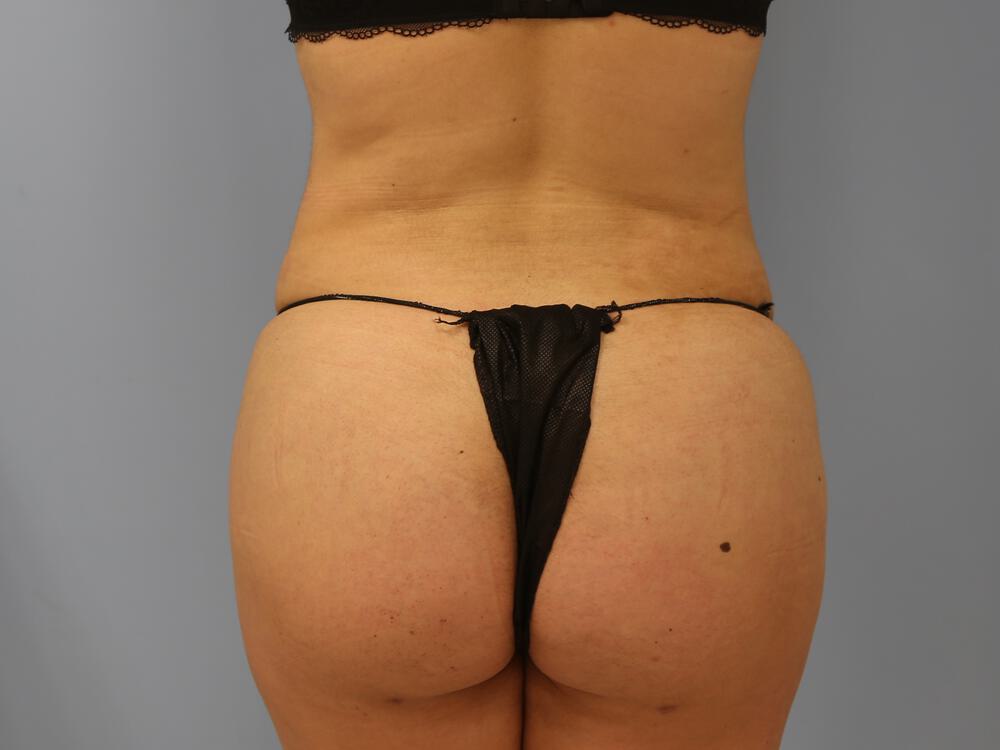 Buttocks Reshaping Before & After Image